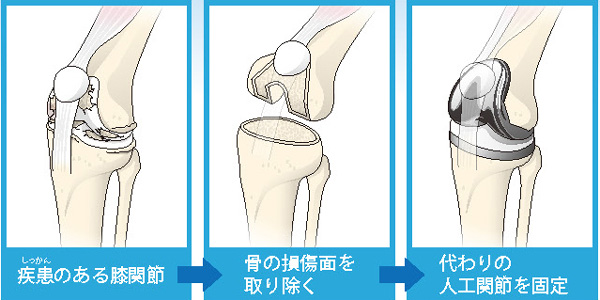 全置換術の流れ