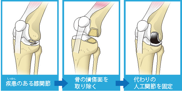 単顆置換術の流れ