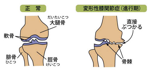 正常な膝と変形性膝関節症
