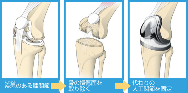 人工膝関節置換術の流れ