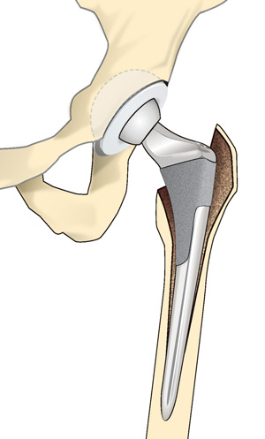 人工股関節置換術