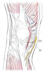 Subvastus アプローチ