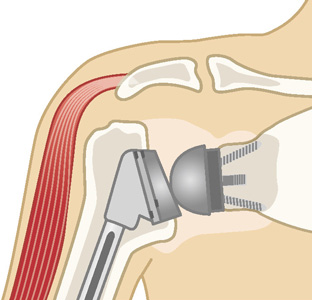リバース型人工肩関節