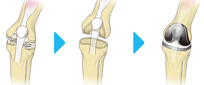 人工膝関節全置換術の流れ