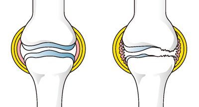 正常な膝（左）と軟骨がすり減り炎症のおきた膝（右）