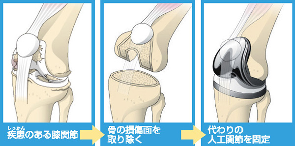 人工膝関節置換術の流れ