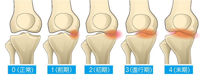人変形性膝関節症の5段階