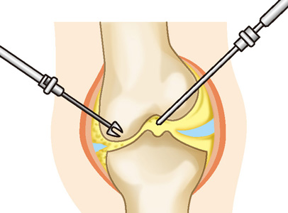 関節鏡視下手術