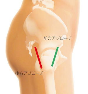 後方アプローチと前方アプローチ