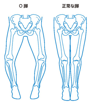 O脚と正常な脚