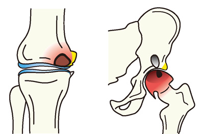 特発性大腿骨内顆骨壊死と特発性大腿骨頭壊死症