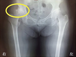 変形性股関節症（右）の患者さんの手術前のX線写真。右股関節の軟骨がすり減り、骨同士がぶつかっている（白い箇所）