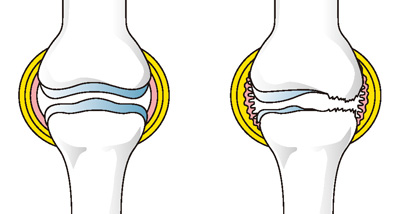 正常な膝（左）と炎症の起きた膝（右）