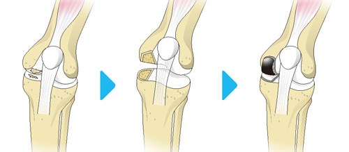 人工膝関節単顆型置換術の流れ