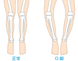 正常な膝とO脚