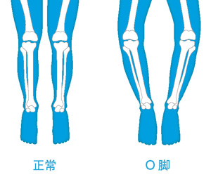 正常な膝とO脚