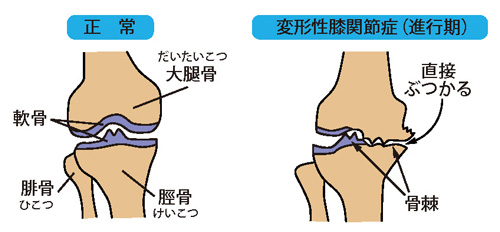 正常な膝と変形性膝関節症（進行期）