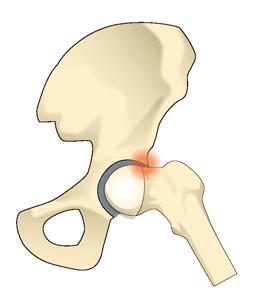 人大腿骨寛骨臼インピンジメント