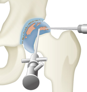 股関節鏡手術