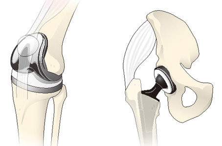 人工膝関節置換術（左）、人工股関節置換術（右）