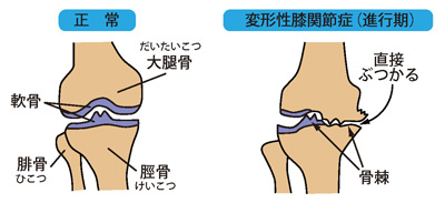 正常な膝と変形性膝関節症（進行期）