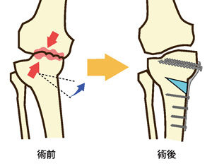 高位脛骨骨切り術