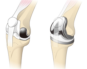 人工膝関節部分置換術（左）と全置換術（右）
