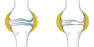 正常な膝（左）と炎症の起きた膝（右）