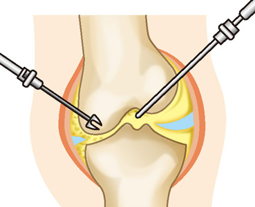 関節鏡視下手術