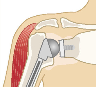 従来型人工肩関節置換術