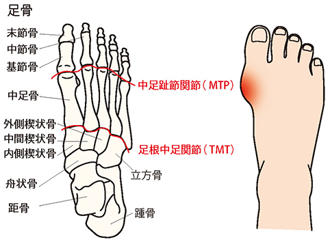 田中 康仁 先生 外反母趾を発症する外的要因と内的要因 適切な治療タイミングを逃さないためにも外反母趾は我慢せず専門医に相談を 人工関節 ドットコム