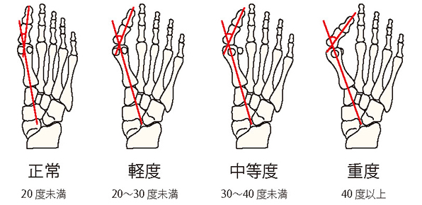 外反母趾角重症度