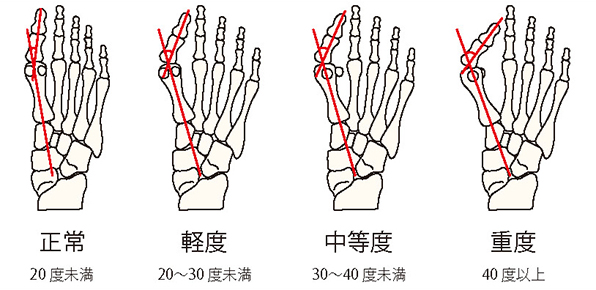 外反母趾角重症度