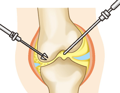 関節鏡視下手術