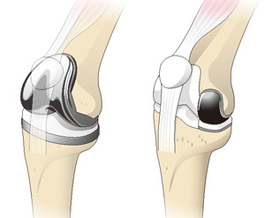 人工膝関節全置換術（左）と単顆置換術（右）