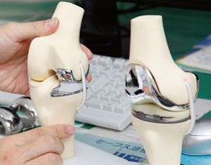 人工膝関節単顆置換術と全置換術の一例