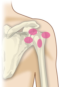 肩関節周囲炎