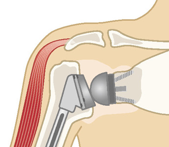 リバース型人工肩関節置換術