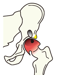 大腿骨頭壊死症