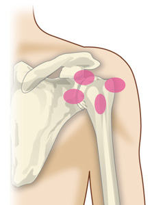 肩関節周囲炎