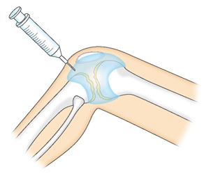 関節内へのヒアルロン酸注射