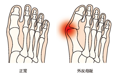 正常な足と外反母趾