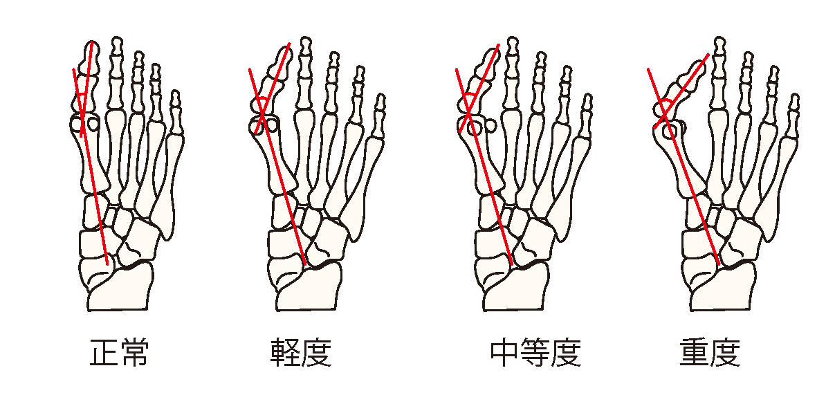 外反母趾角重症度