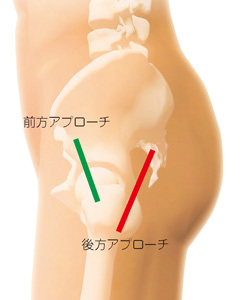 前方アプローチと後方アプローチ