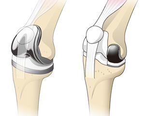 人工膝関節全置換術（左）と部分置換術（右）
