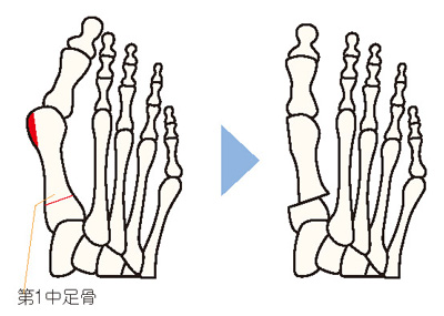 親指の第一中足骨（ちゅうそっこつ）という骨を切って変形を矯正する「骨（こつ）切り術」