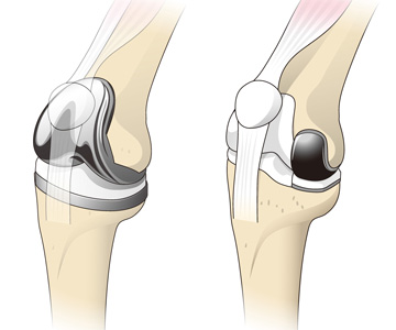 人工膝関節全置換術（左）と部分置換術（右）