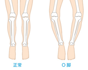 正常な足とO脚