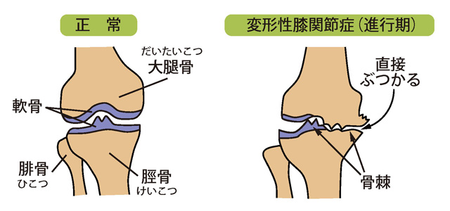 正常な膝と変形性膝関節症（進行期）