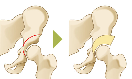 骨切り術（股関節）
